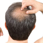 causes and treatments of hairloss in teenage males (1)