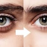 How to remove dark eye circles