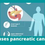 What causes pancreatic cancer