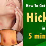 how to get rid of hickey