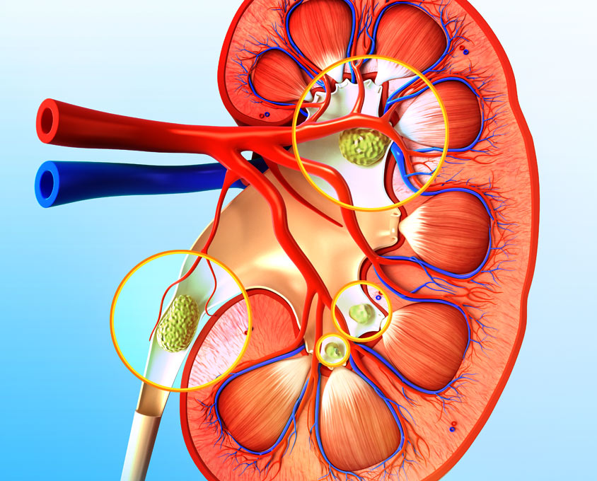 Symptoms Of Kidney Stones