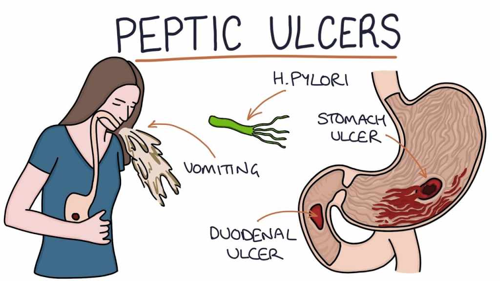 Symptoms Of Stomach Ulcer