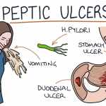 Symptoms Of Stomach Ulcer