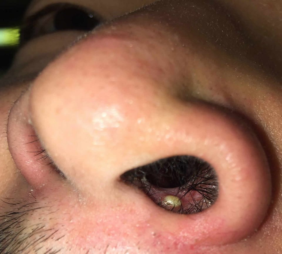 Pimple inside nose