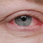 how long is pink eye contagious