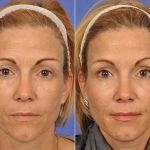 under eye botox before and after